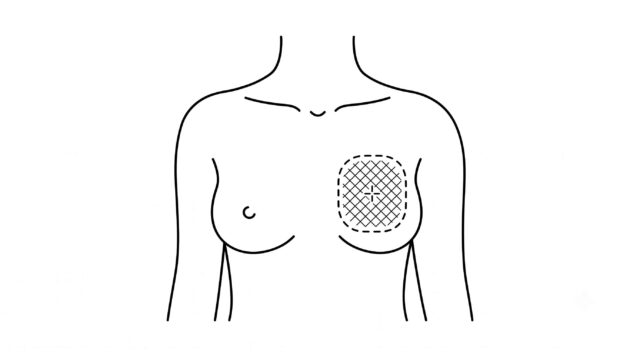 乳房部分切除術